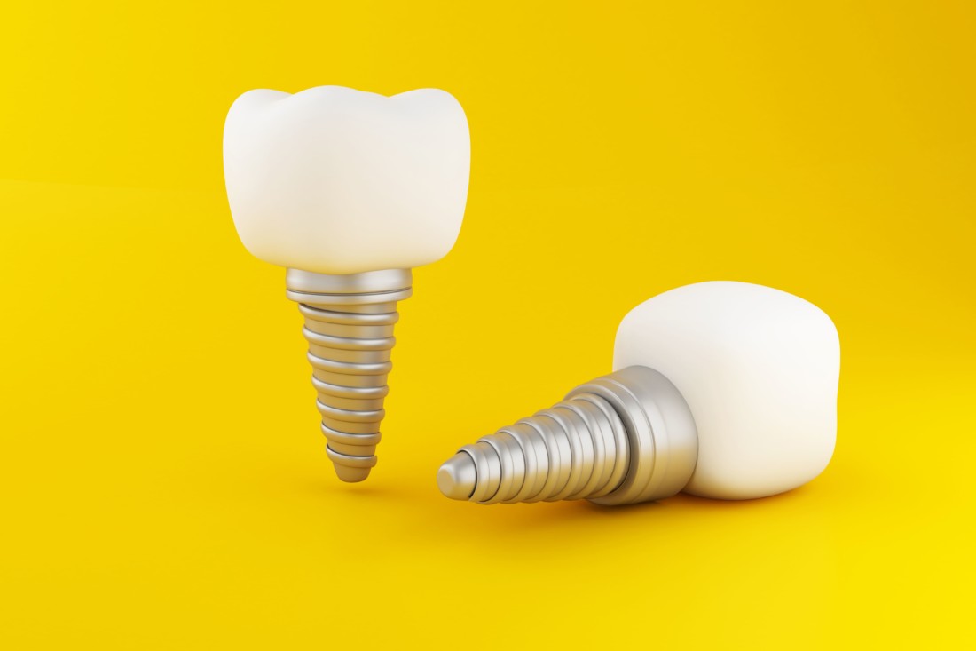 Какие есть способы имплантации зубов?