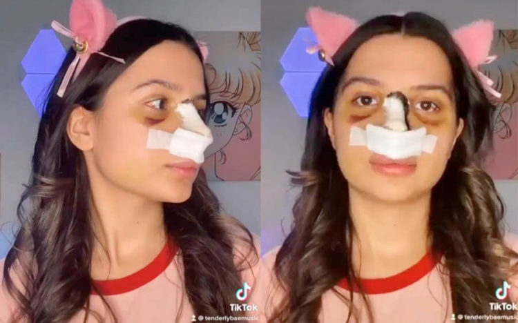 Как выглядит нос Tenderlybae после операции без маски до и после?